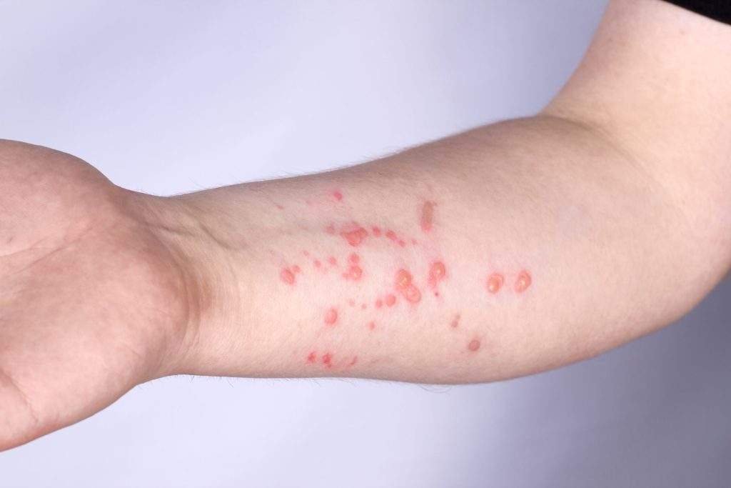 Monkeypox rash on arm