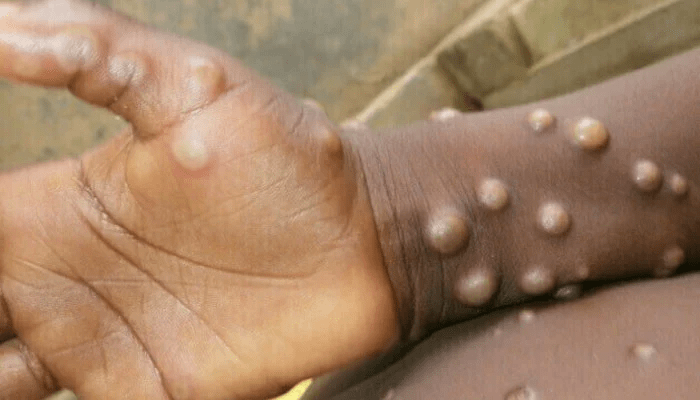 monkeypox-epidemic