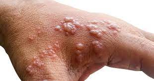 monkeypox mpox rash on hands