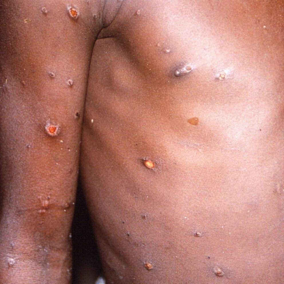 mpox lesions on chest monkey pox lesions rash on chest and arms